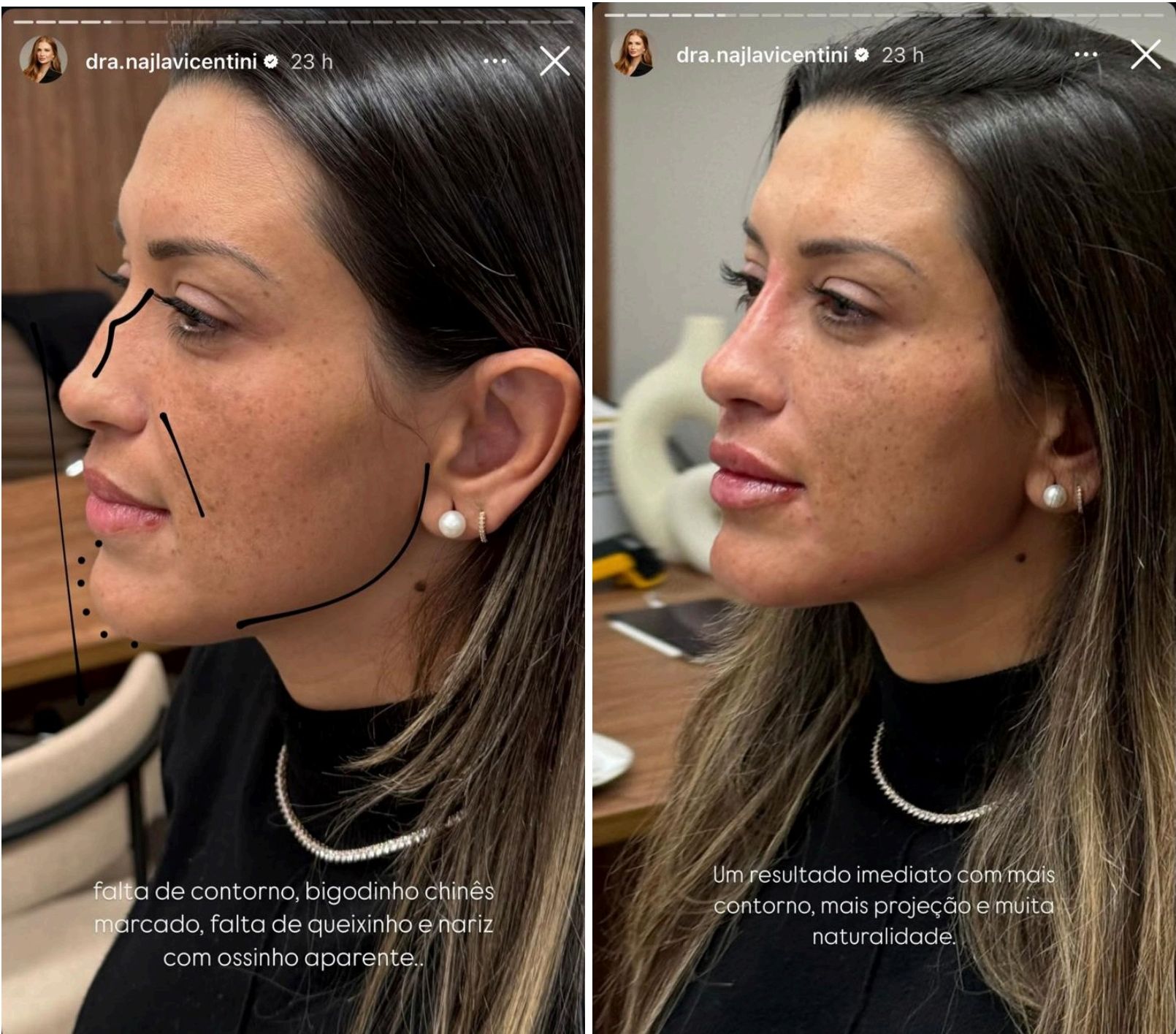 Perfil — Depois